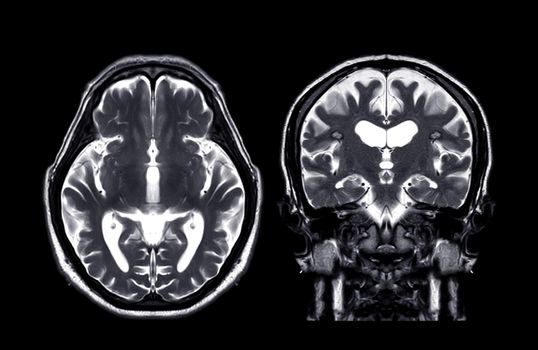 MRI brain Axial T2 and coronal t2 f technique for detect a variety of conditions of the brain such as cysts, tumors, bleeding and stroke diseases.