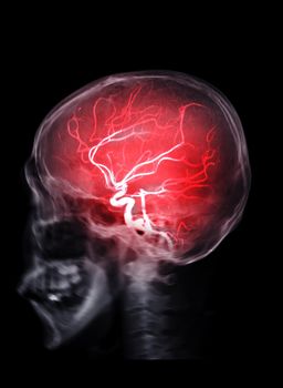 Skull image fusion with MRI MRA Brain for evaluate them stenosis and stroke disease.