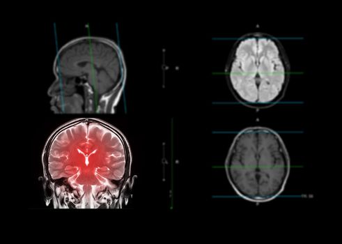 MRI brain showing coronal plane of the brain for detect stroke disease and Brain tumors and cysts.