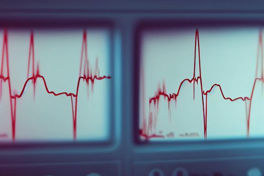 Electrocardiogram, EKG, heart rate monitor showing a specific illness in hospital room for checking heart rate hospitalized patients