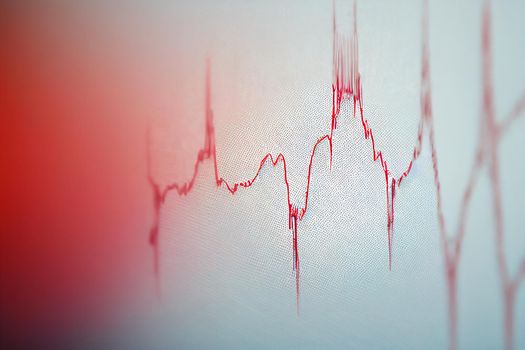 Electrocardiogram, EKG, heart rate monitor showing a specific illness in hospital room for checking heart rate hospitalized patients