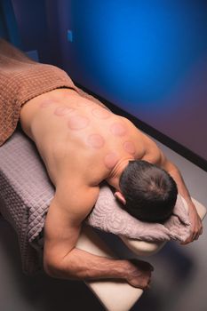 back of an athletic male client with traces, after massage with medical cups. relaxation in the spa salon on the massage table.