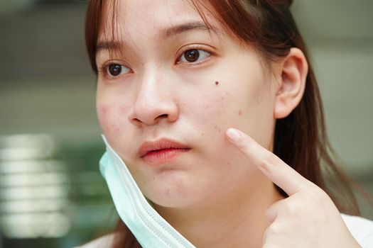 Acne pimple and scar on skin face, disorders of sebaceous glands, teenage girl skincare beauty problem.
