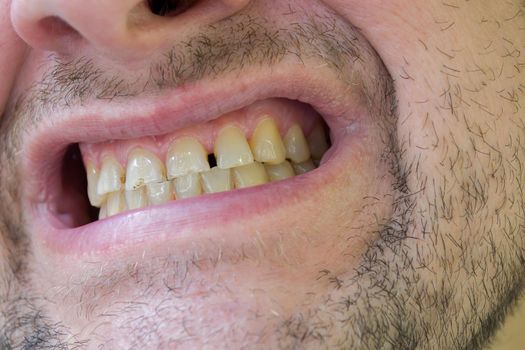 Not tight fitting yellow teeth of a man with plaque and caries.