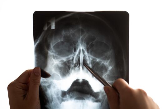 The doctor looks at the x-ray of the sinuses