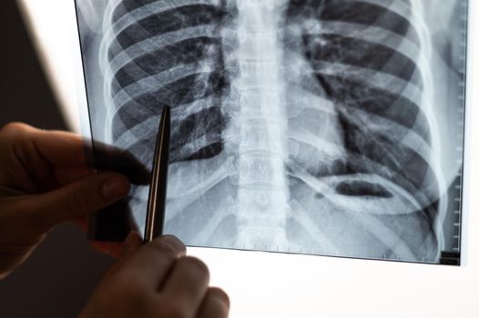 Doctor showing x-ray of patient's lungs