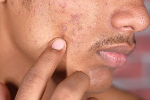 close up of young boy with dermatology skin problem .