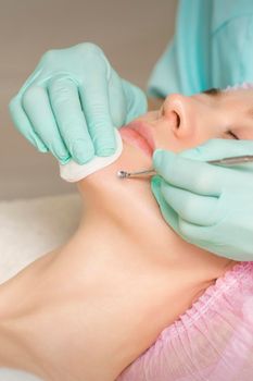 Facial cleansing. Blackhead Removal Tool. Beautician removing blackhead and acne on female chin in a beauty salon