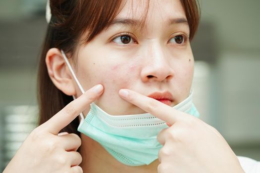 Acne pimple and scar on skin face, disorders of sebaceous glands, teenage girl skincare beauty problem.