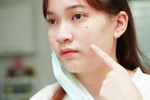 Acne pimple and scar on skin face, disorders of sebaceous glands, teenage girl skincare beauty problem.