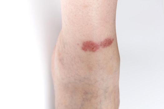 Redness on the skin of the leg from an insect bite. Copy space