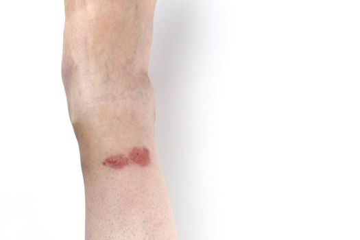 Redness on the skin of the leg from an insect bite. Copy space