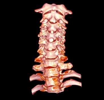 CT SCAN of Cervical Spine ( C-spine ) patient trauma case 3D rendering image .