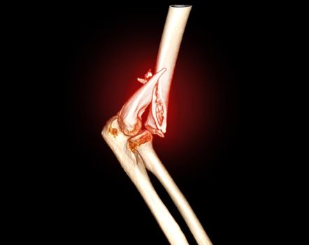 Computed Tomography Volume Rendering examination of elbow joint 3D rendering in patient fracture elbow joint.