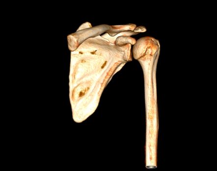 Computed Tomography Volume Rendering examination of the Shoulder 3D rendering in patient fracture shoulder joint.
