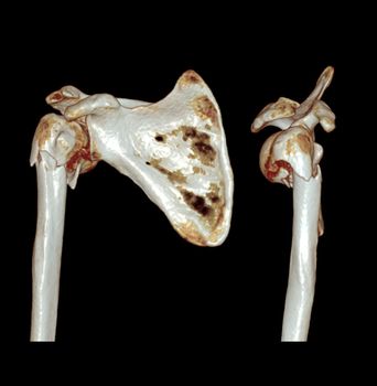 Computed Tomography Volume Rendering examination of the Shoulder 3D rendering in patient fracture shoulder joint.