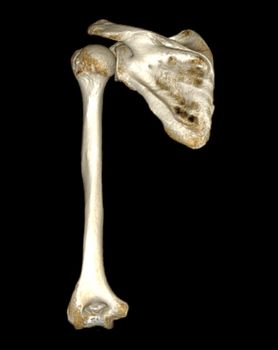 Computed Tomography Volume Rendering examination of the shoulder joint and humerus bone 3D rendering in patient fracture shoulder joint and humerus bone .