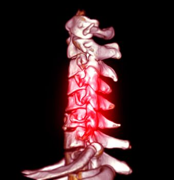 CT SCAN of Cervical Spine ( C-spine ) patient trauma case 3D rendering image .