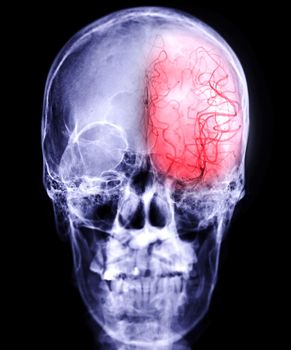 Cerebral angiography image from Fluoroscopy with skull of human showing cerebral artery.