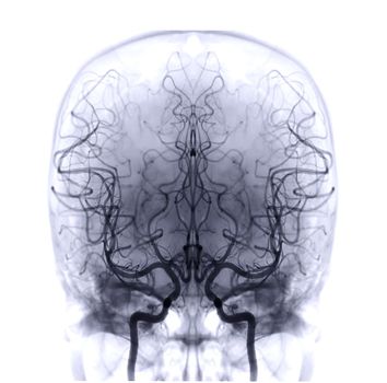 Cerebral angiography image from Fluoroscopy in intervention radiology showing cerebral artery.