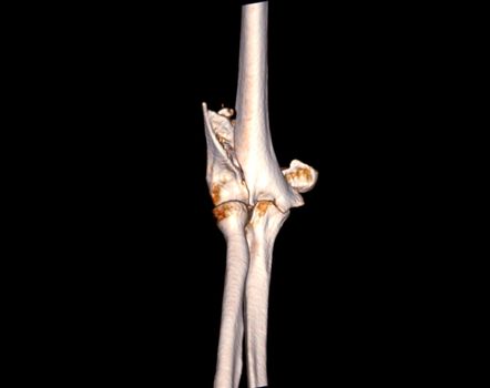Computed Tomography Volume Rendering examination of elbow joint 3D rendering in patient fracture elbow joint.