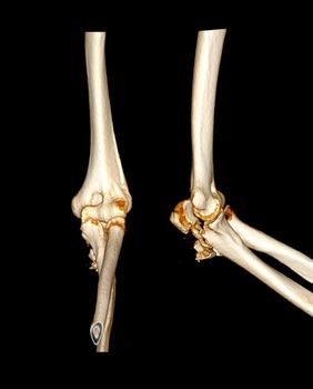 Computed Tomography Volume Rendering examination of elbow joint 3D rendering in patient fracture elbow joint.