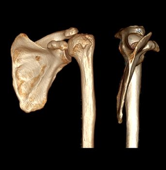 Computed Tomography Volume Rendering examination of the Shoulder 3D rendering in patient fracture shoulder joint.