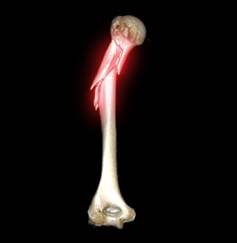 Computed Tomography Volume Rendering examination of the shoulder joint and humerus bone 3D rendering in patient fracture shoulder joint and humerus bone .