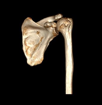 Computed Tomography Volume Rendering examination of the Shoulder 3D rendering in patient fracture shoulder joint.