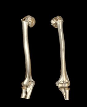 Computed Tomography Volume Rendering examination of the shoulder joint and humerus bone 3D rendering in patient fracture shoulder joint and humerus bone .