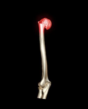 Computed Tomography Volume Rendering examination of the shoulder joint and humerus bone 3D rendering in patient fracture shoulder joint and humerus bone .