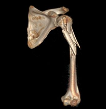 Computed Tomography Volume Rendering examination of the shoulder joint and humerus bone 3D rendering in patient fracture shoulder joint and humerus bone .