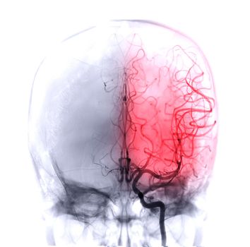 Cerebral angiography image from Fluoroscopy in intervention radiology showing cerebral artery.