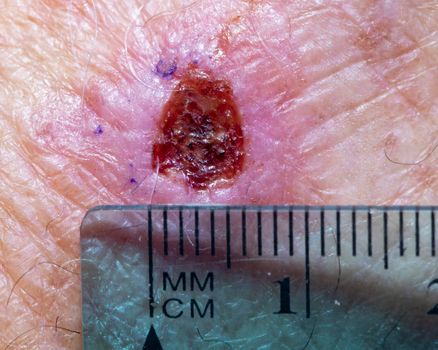 Skin cancer incisional biopsy site on the back of a male hand.