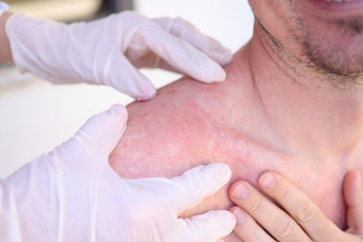 Doctor in gloves conducts initial examination of man with sunburn on skin of his shoulders and back. First aid for sunburn in adults