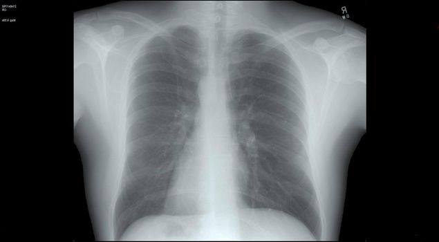 Chest x-ray of the human body over a black background for coronavirus or Covid-19 concepts