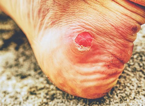 Legs of traveler with blister on top of mountain outdoor.  Hurt male heel