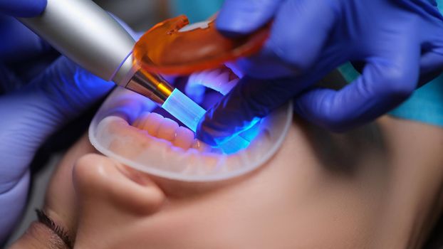 Doctor dentist illuminating filling with modern light lamp in clinic closeup. Modern methods of caries treatment concept