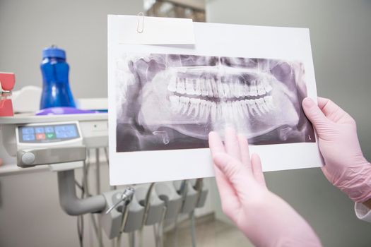 Close up of jaw x-ray scan in hands of unrecognizable dentist