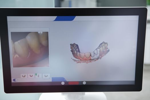 Close up of dental scan on computer screen at dentists office