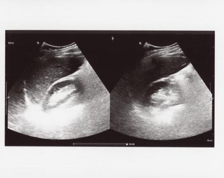 full abdomen ultrasound image aka diagnostic sonogram