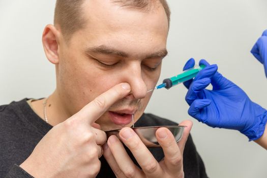 A nurse rinses the nasal cavity of a patient suffering from sinusitis with saline solution using a syringe.