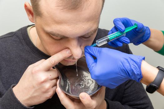 A nurse rinses the nasal cavity of a patient suffering from sinusitis with saline solution using a syringe.