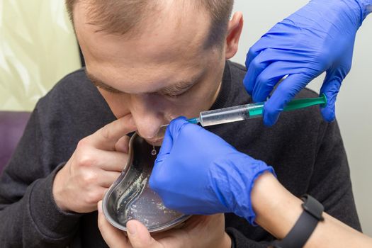 A nurse rinses the nasal cavity of a patient suffering from sinusitis with saline solution using a syringe.