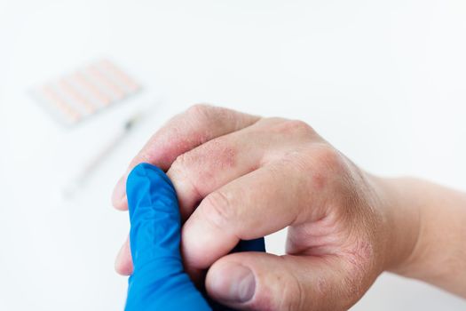 A man shows a reddened rash on his hands to the doctor. Causes of itchy skin can be dermatitis (eczema), dry skin, burns, food allergies. healthcare concept