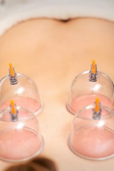 Young caucasian woman receiving cupping therapy in spa clinic. Islamic female medicine