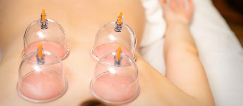 Young caucasian woman receiving cupping therapy in spa clinic. Islamic female medicine