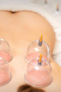 Young caucasian woman receiving cupping therapy in spa clinic. Islamic female medicine