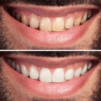 Closeup of man teeth before and after whitening or bleaching of smiling man. Dental health Concept. Oral Care concept