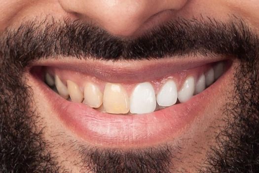 Closeup of man teeth before and after whitening or bleaching of smiling man. Dental health Concept. Oral Care concept